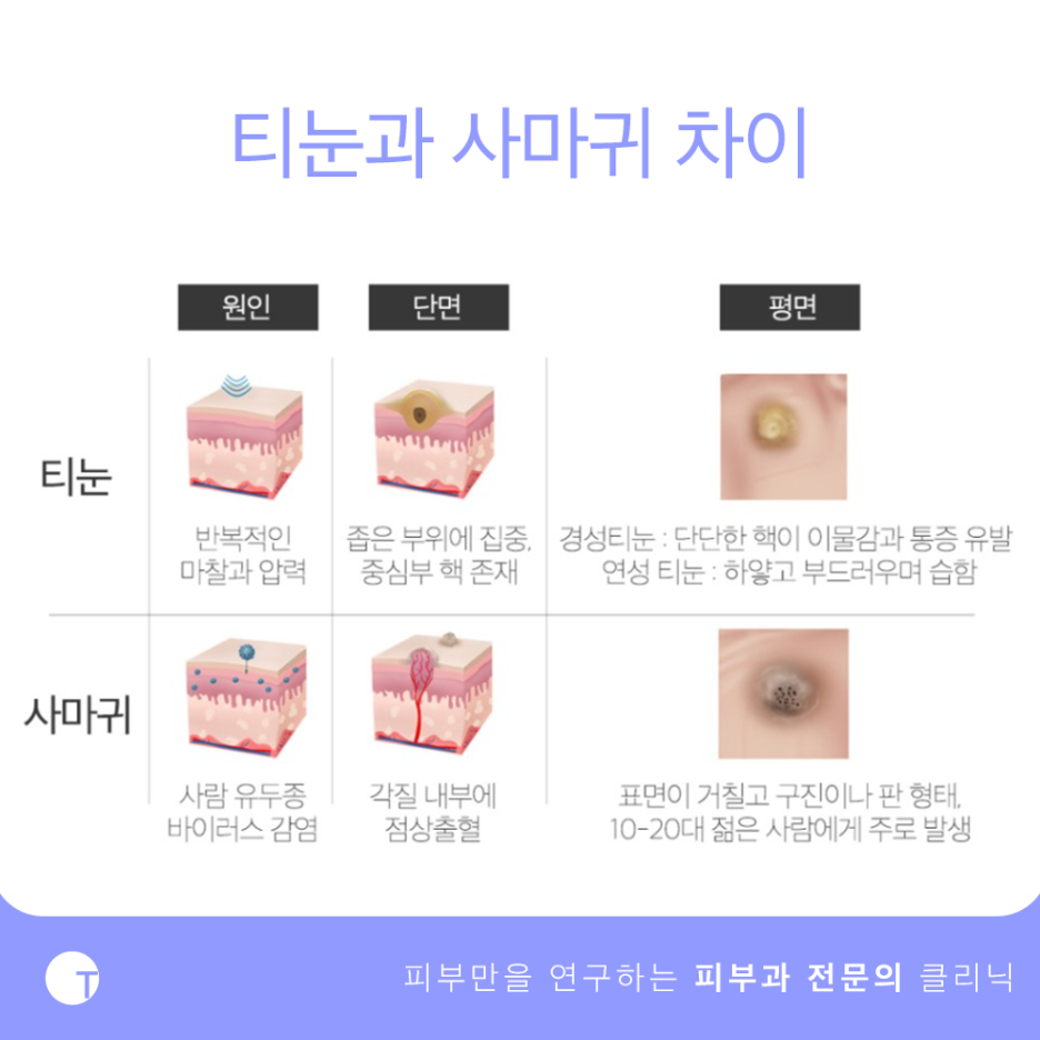 역삼역티눈제거 뿌리까지 확실하게 관련 이미지 2