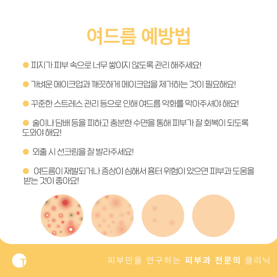 여드름 원인 궁금하다면 관련 이미지 4