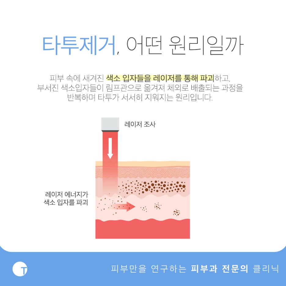 강남타투제거 기폭문신제거의 차이점은 관련 이미지 2