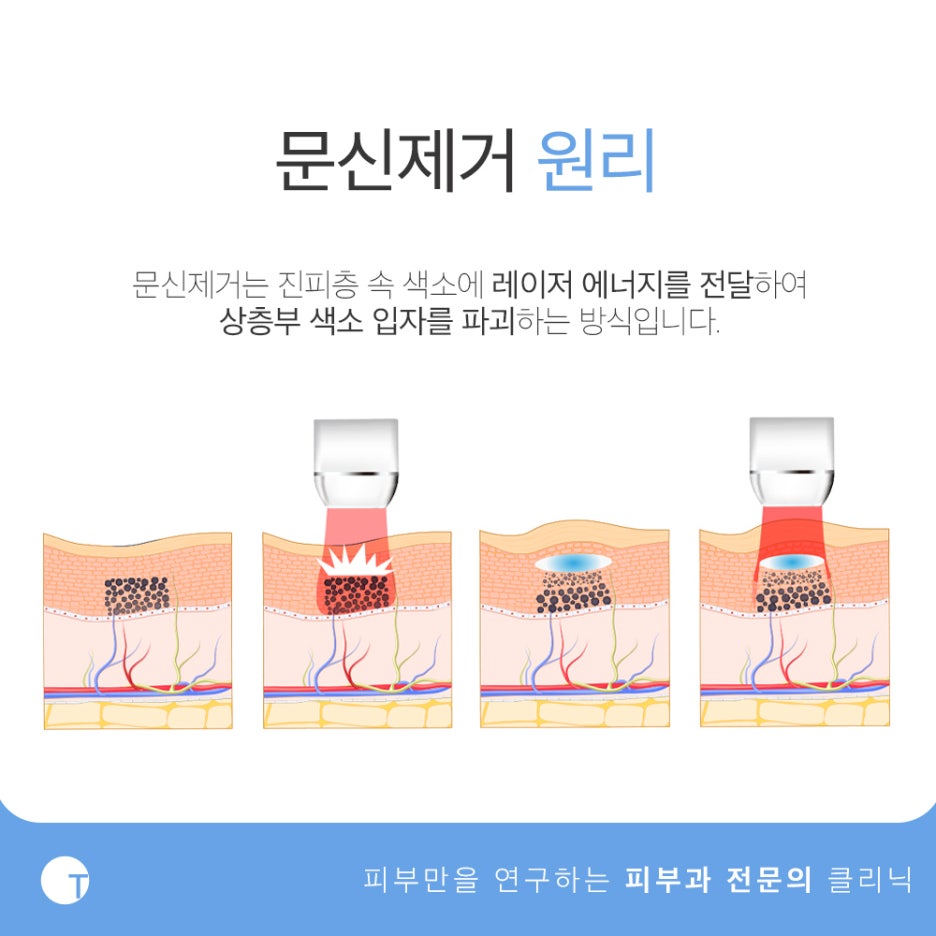 역삼역문신제거 적은 횟수로 확실하게 관련 이미지 2