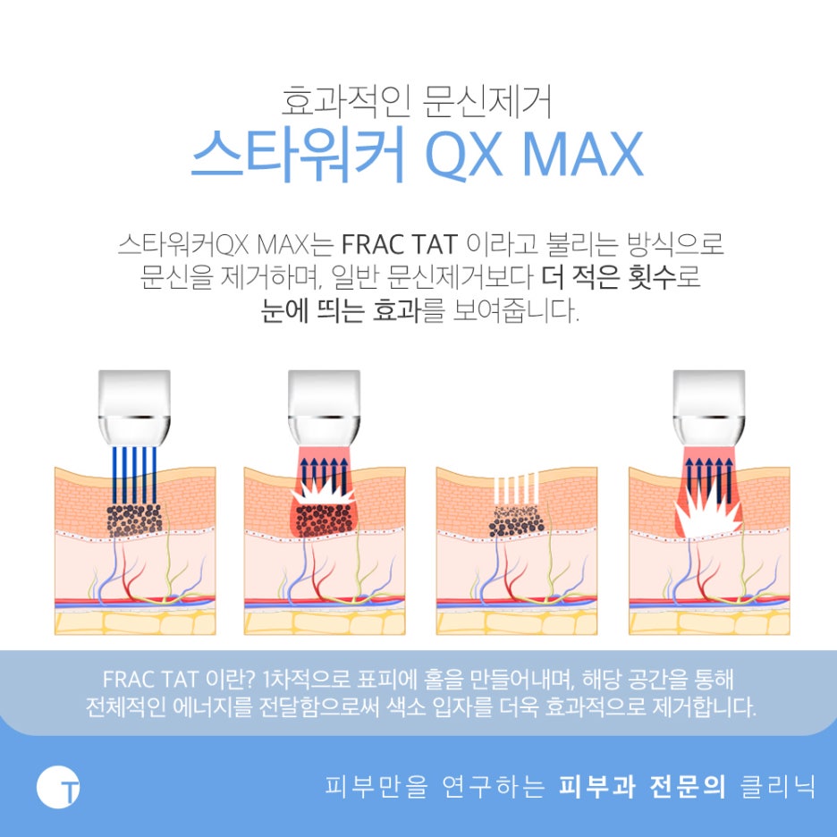 역삼역문신제거 적은 횟수로 확실하게 관련 이미지 3