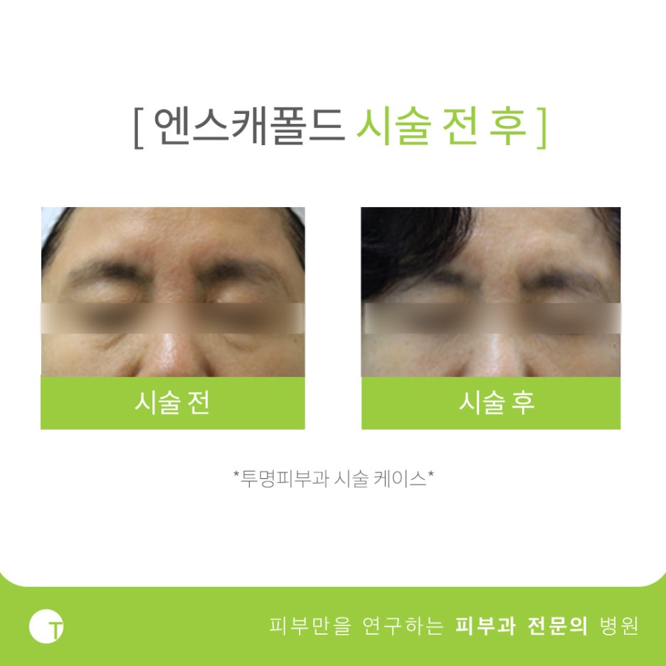 역삼역실리프팅 엔스캐폴드로 주름은 없애고 탄력은 살리고 관련 이미지 5