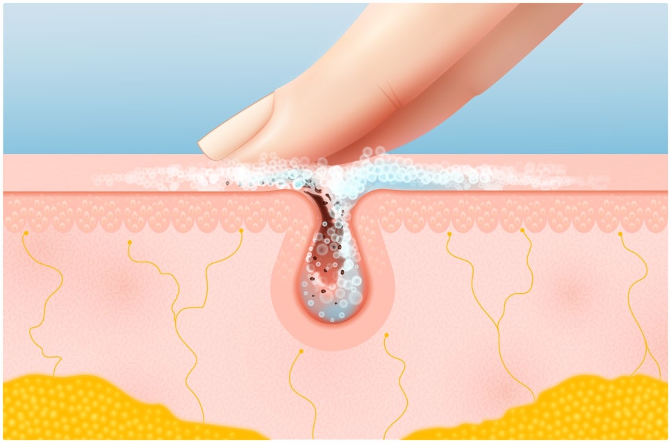 To a Clear Skin Clinic That Uses Only High-End Products in Gangnam Ellevie Rituo! image 5