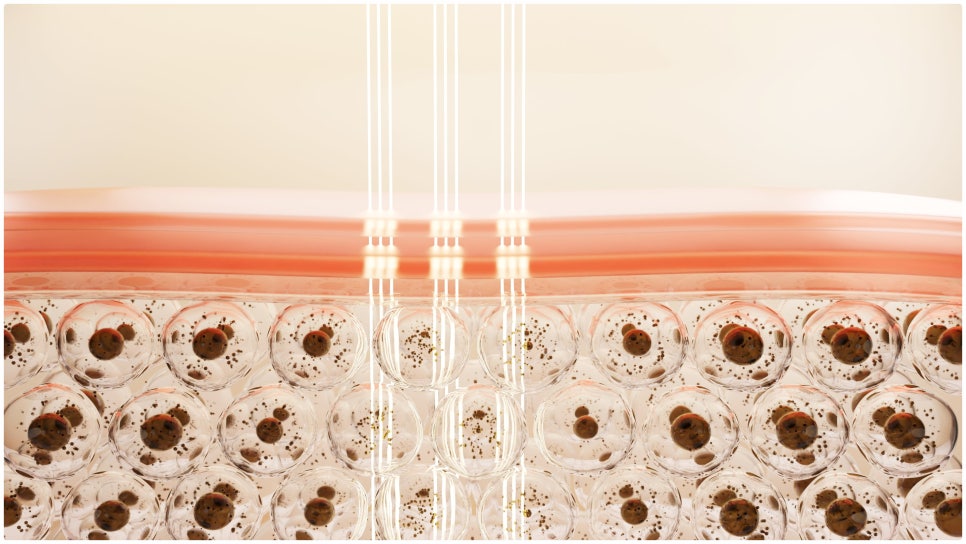 Treating Melasma Near Yeoksam Station with a Variety of Devices image 2