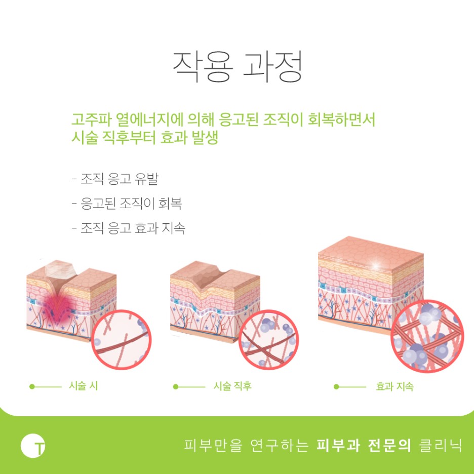 역삼역볼뉴머피부과 개인별로 맞춤형이 가능한 관련 이미지 4