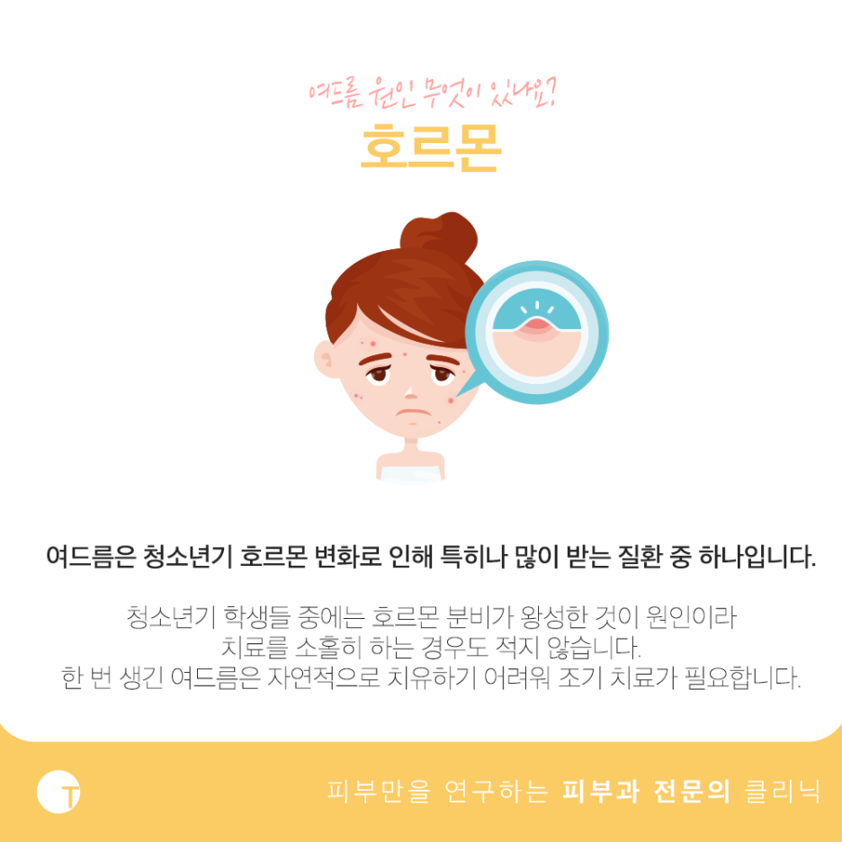 여드름 원인 궁금하다면 관련 이미지 3