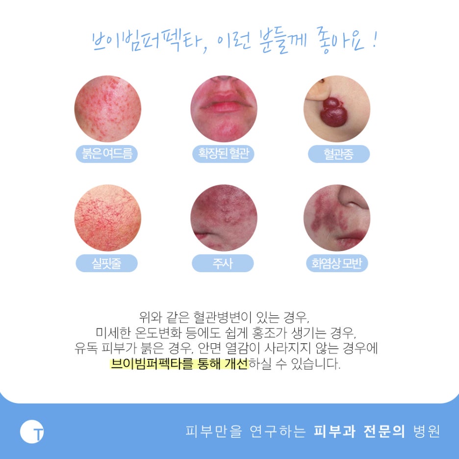 역삼역안면홍조 브이빔퍼펙타로 해결해요 관련 이미지 4