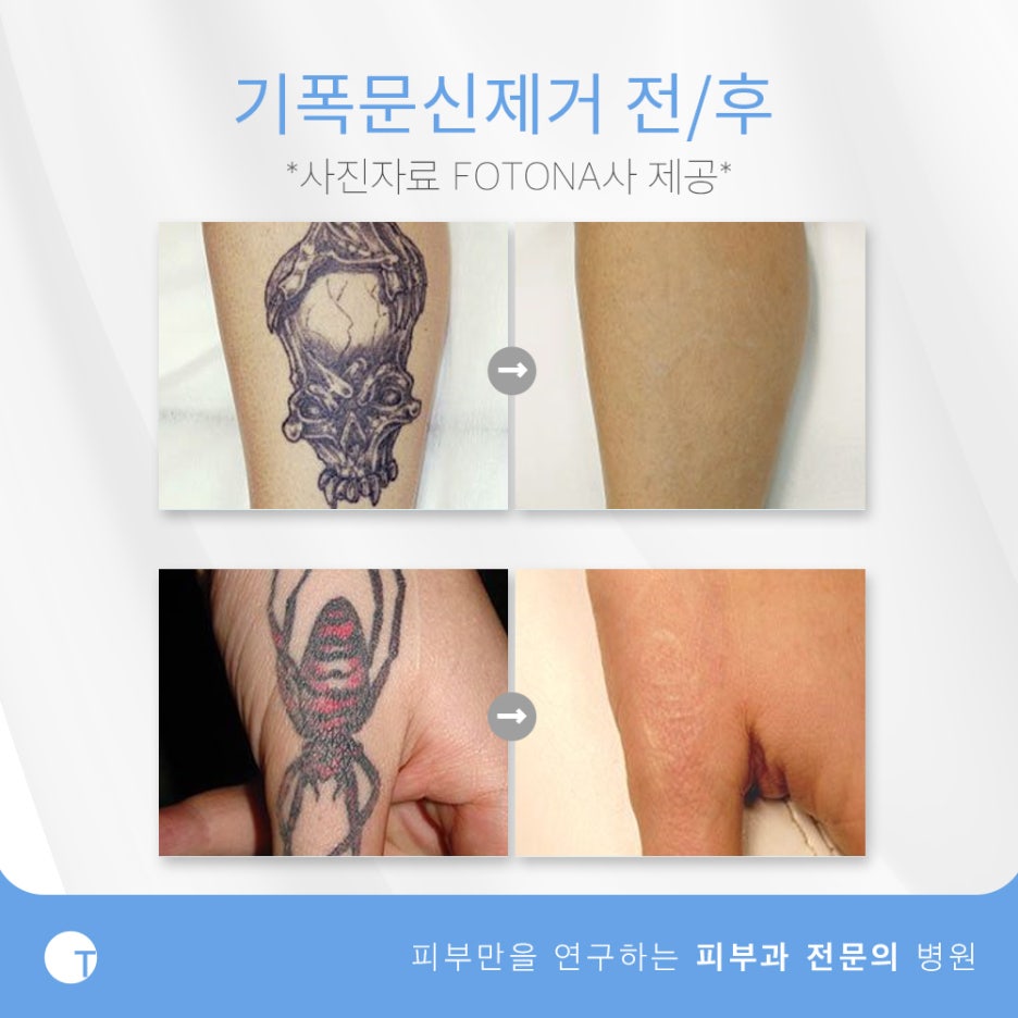 역삼동문신제거 피부손상은 줄이고 효과는 높이고 관련 이미지 6