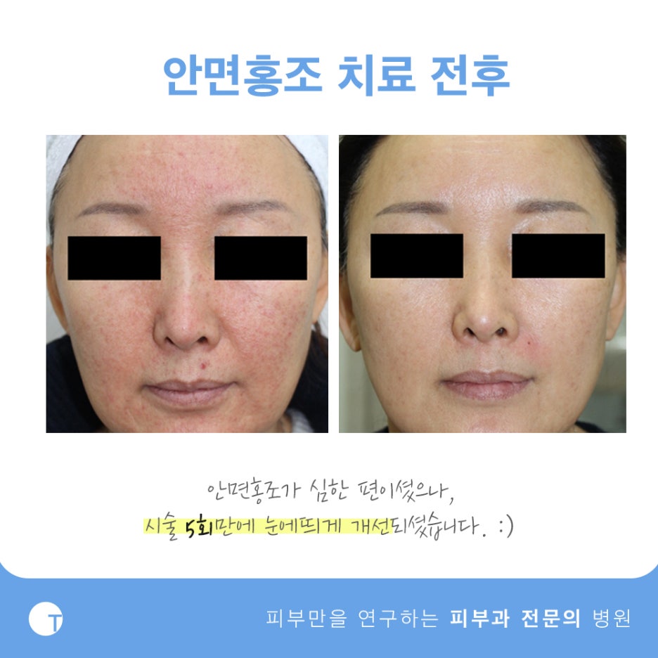 역삼역안면홍조 브이빔퍼펙타로 해결해요 관련 이미지 7