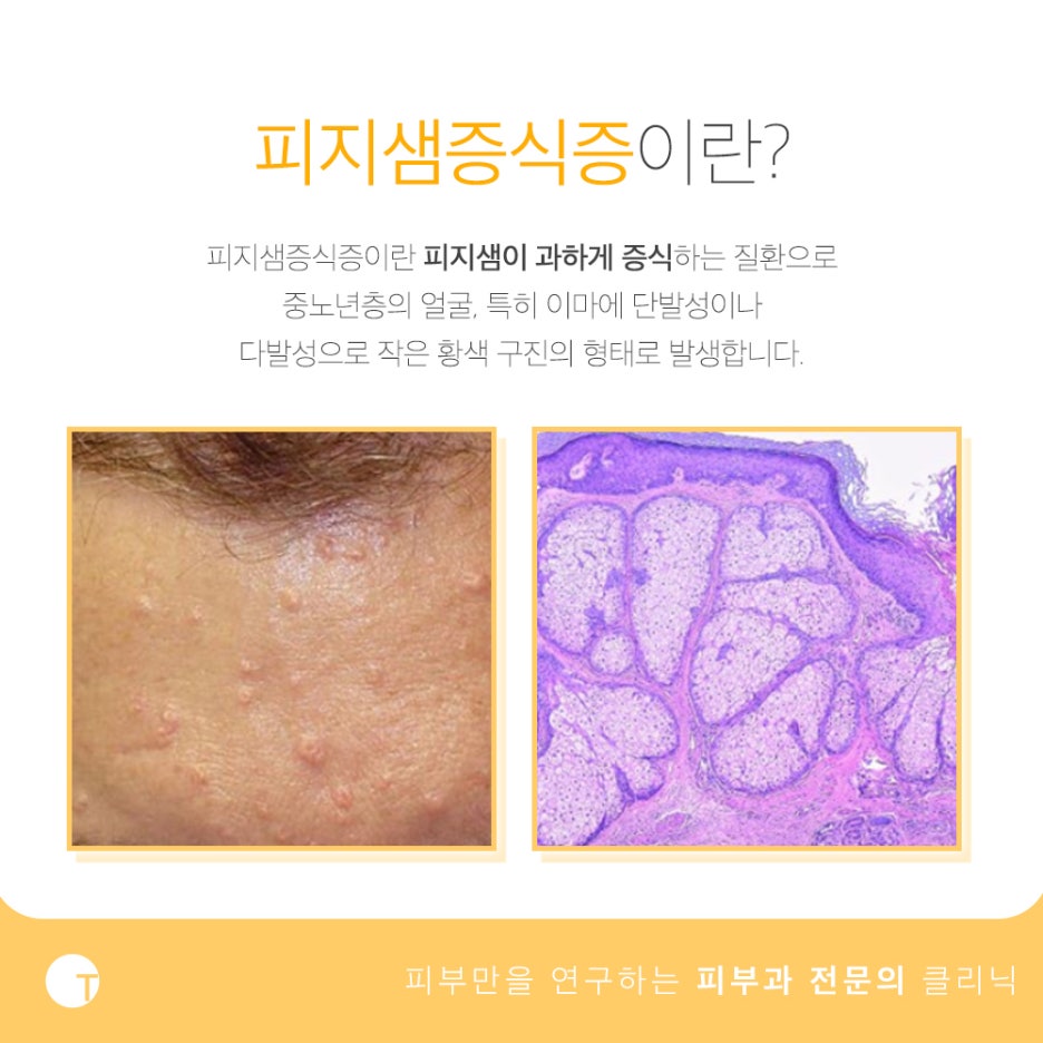 피지샘증식증 증상 어떻게 구분할까 관련 이미지 2