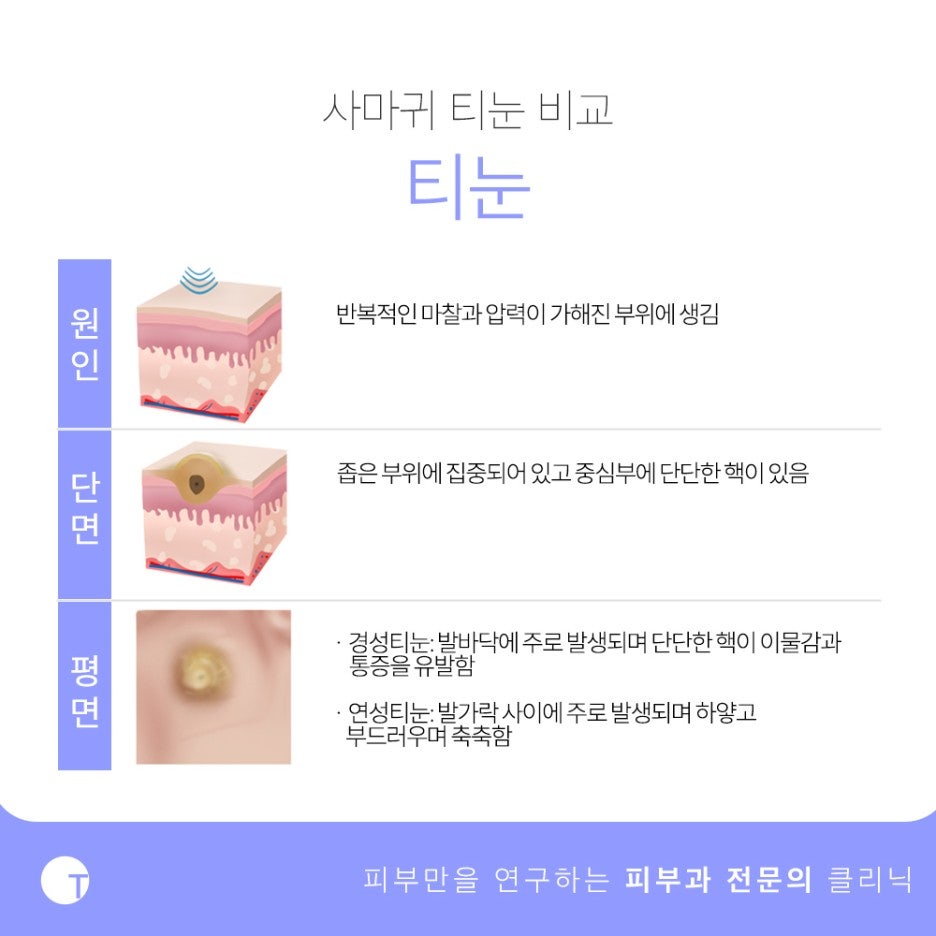 역삼역사마귀치료 확실하게 제거하기 위해서는 관련 이미지 4