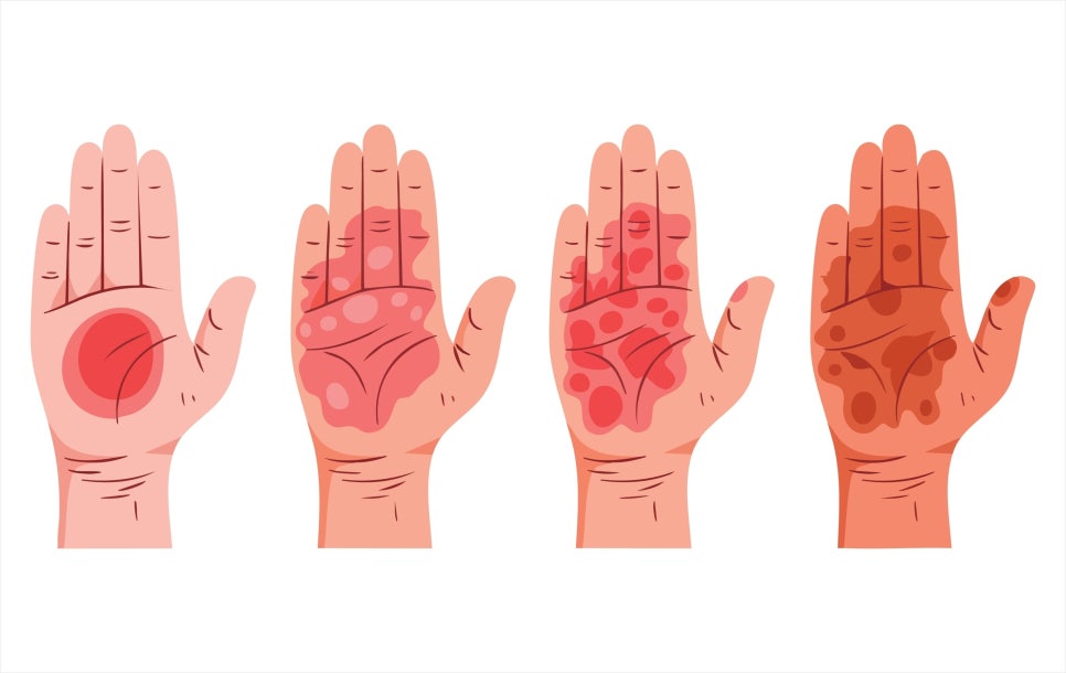 Are You Looking for a Gangnam Burn Treatment Dermatology Clinic? Before Scarring Occurs image 2