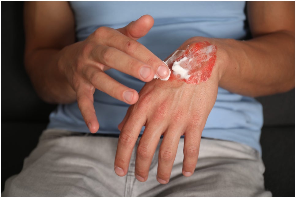 Are You Looking for a Gangnam Burn Treatment Dermatology Clinic? Before Scarring Occurs image 4