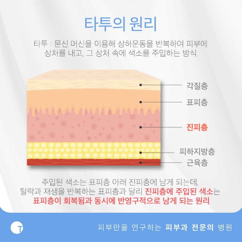 역삼동문신제거 피부손상은 줄이고 효과는 높이고 관련 이미지 2