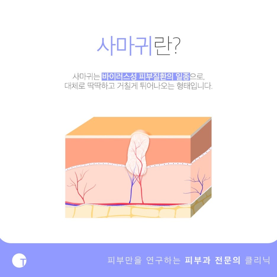 역삼역사마귀치료 확실하게 제거하기 위해서는 관련 이미지 2