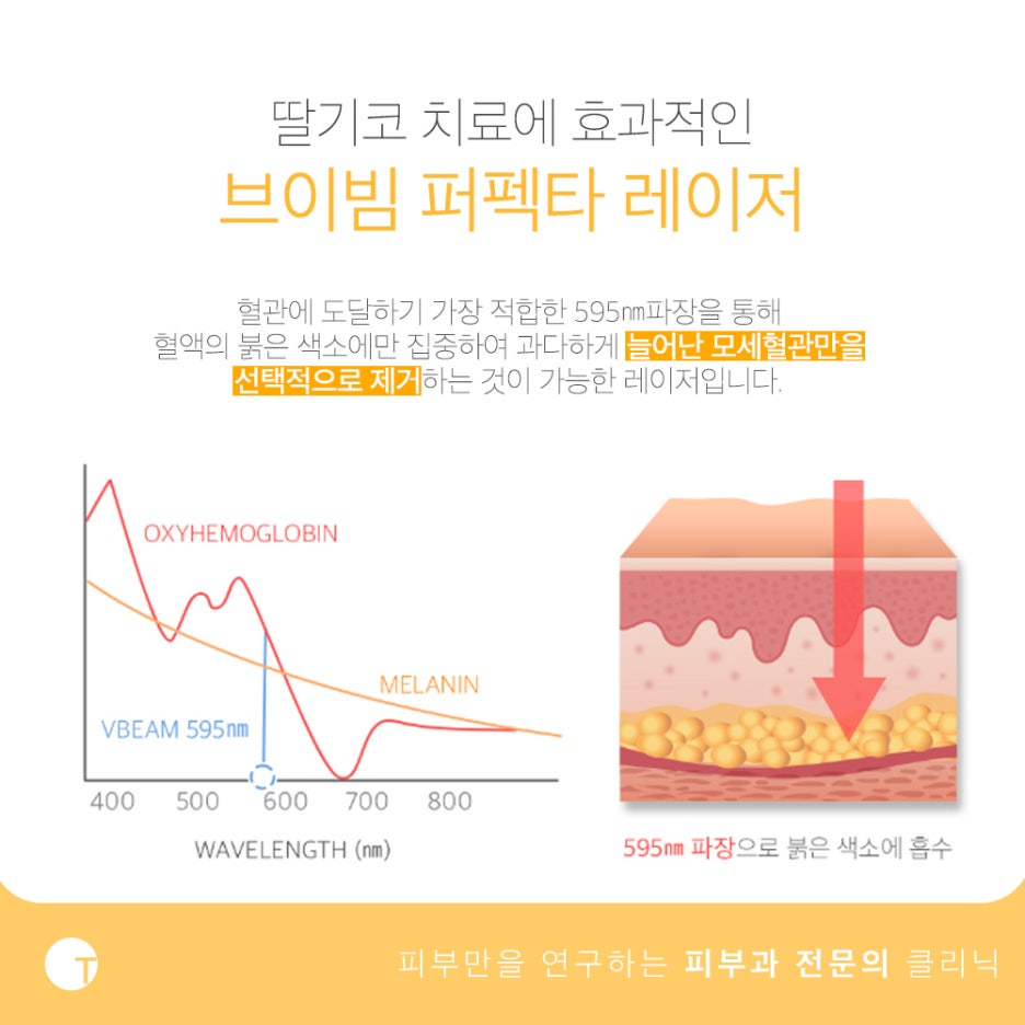 딸기코 치료 브이빔으로 환하게 관련 이미지 3