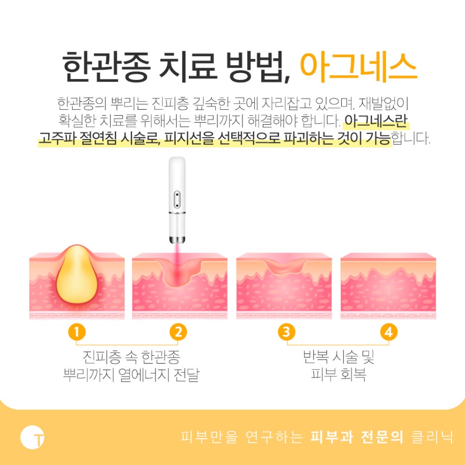 한관종 아그네스 치료 재발 없이 확실하게 관련 이미지 5