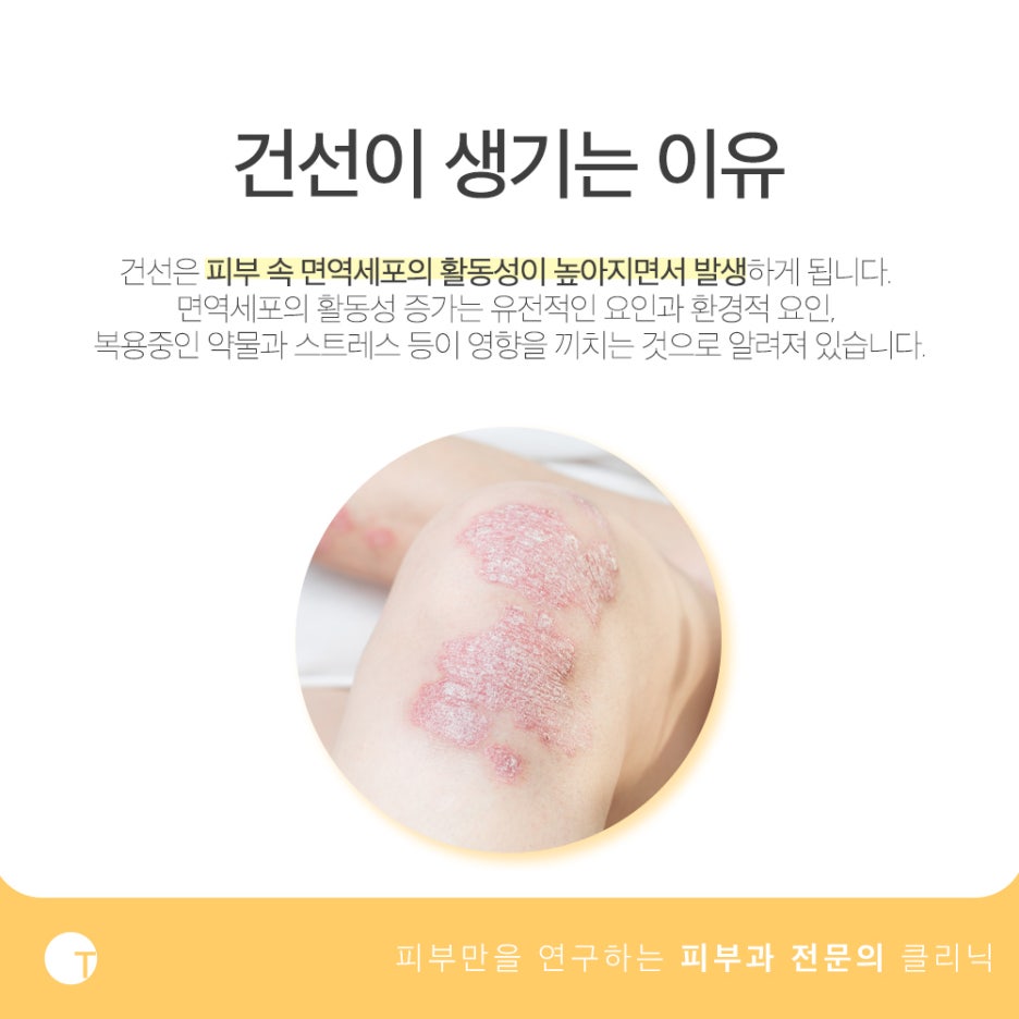 건선 팔라스레이저 보험적용이 가능해요 관련 이미지 2