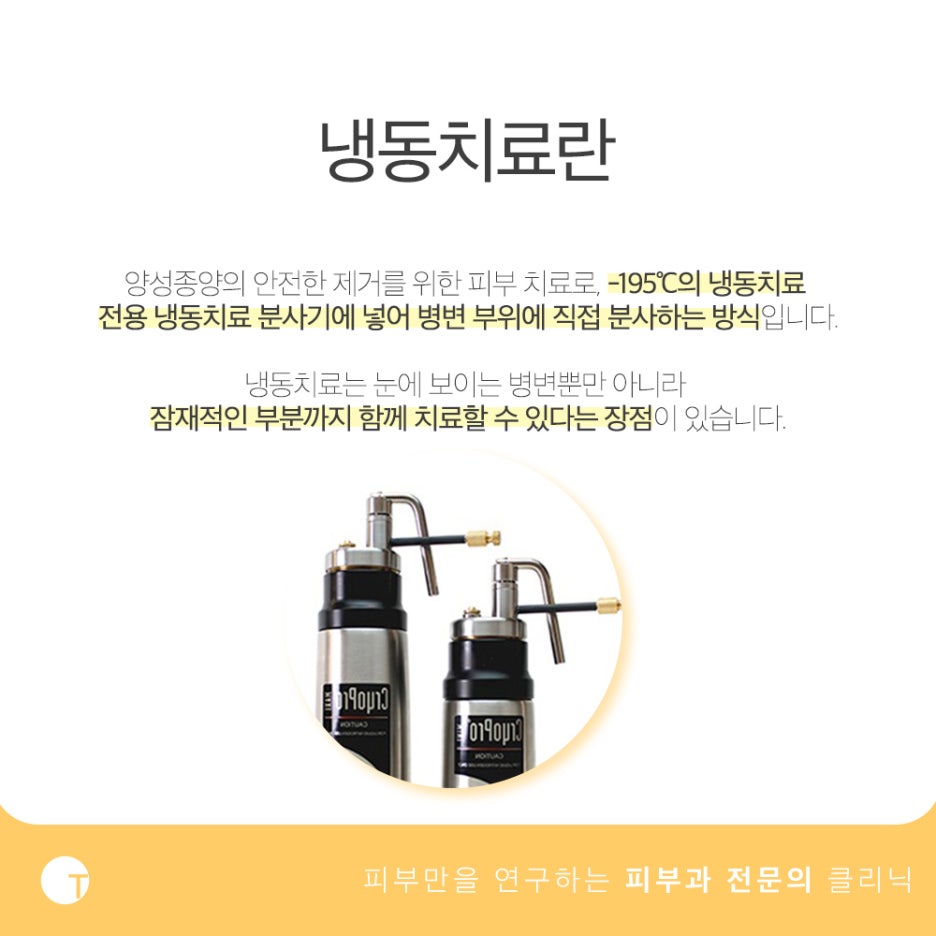 사마귀 티눈 냉동치료 방식과 장점은 관련 이미지 3