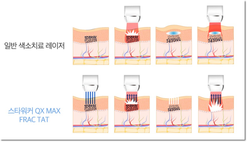 역삼역기미잡티 색소만을 타겟팅하여 관련 이미지 3