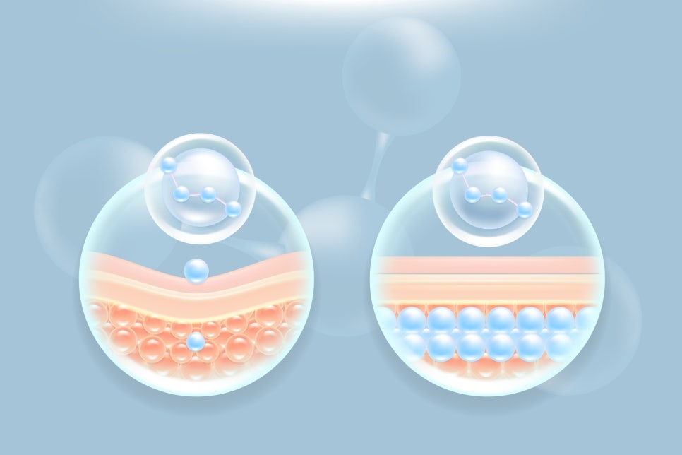 Gangnam Yeoksam Filler: What to Consider for Natural-Looking Changes image 3