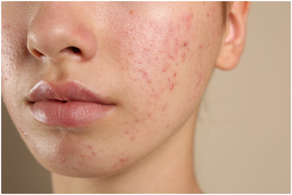 If You’re Stressed by Acne Scars, Yeoksam Gold PTT image 2