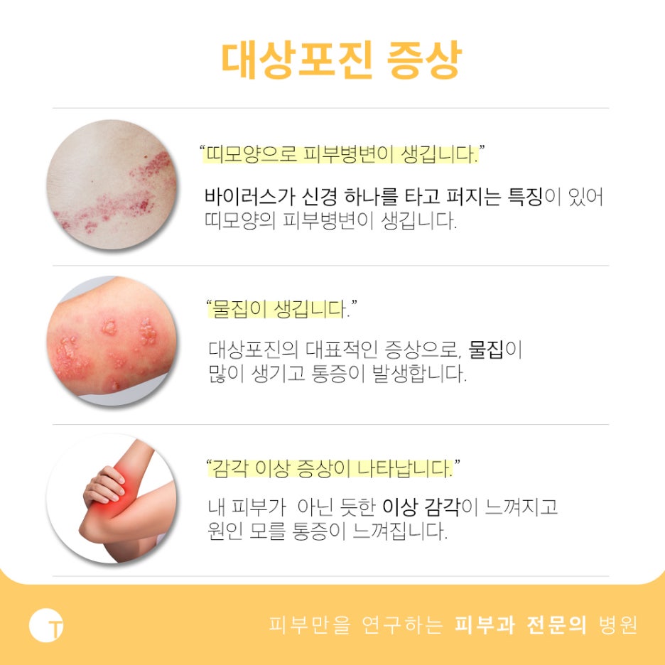 대상포진 증상과 치료방법 알아봐요 관련 이미지 3