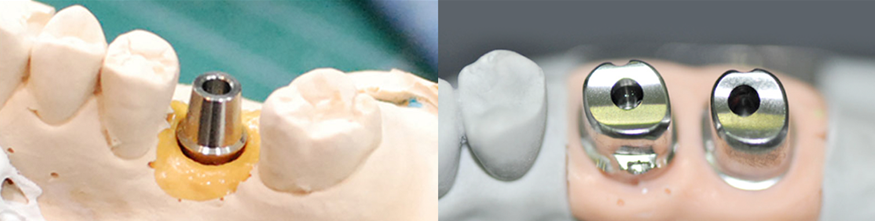 임플란트 부작용 자세히 알아보기(1) 임플란트 보철 (크라운, 지대주, 픽스쳐) 부작용 [ 예방 및 대처 방법 ] [ 강남새로치과 ] 관련 이미지 3