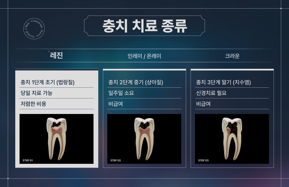 충치치료방법 레진, 인레이/온레이, 크라운 차이 (충치치료비용) 관련 이미지 3