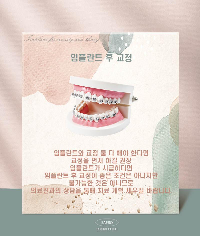 MZ세대 2030을 위한 임플란트 (당일임플란트) 관련 이미지 5