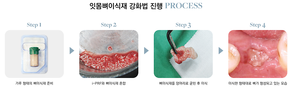 임플란트수술 이란? 부작용 최소화 하려면 반드시 알아야할 것 관련 이미지 9