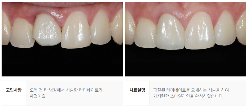 강남역 라미네이트대체 시술 (에어네이트) 관련 이미지 9