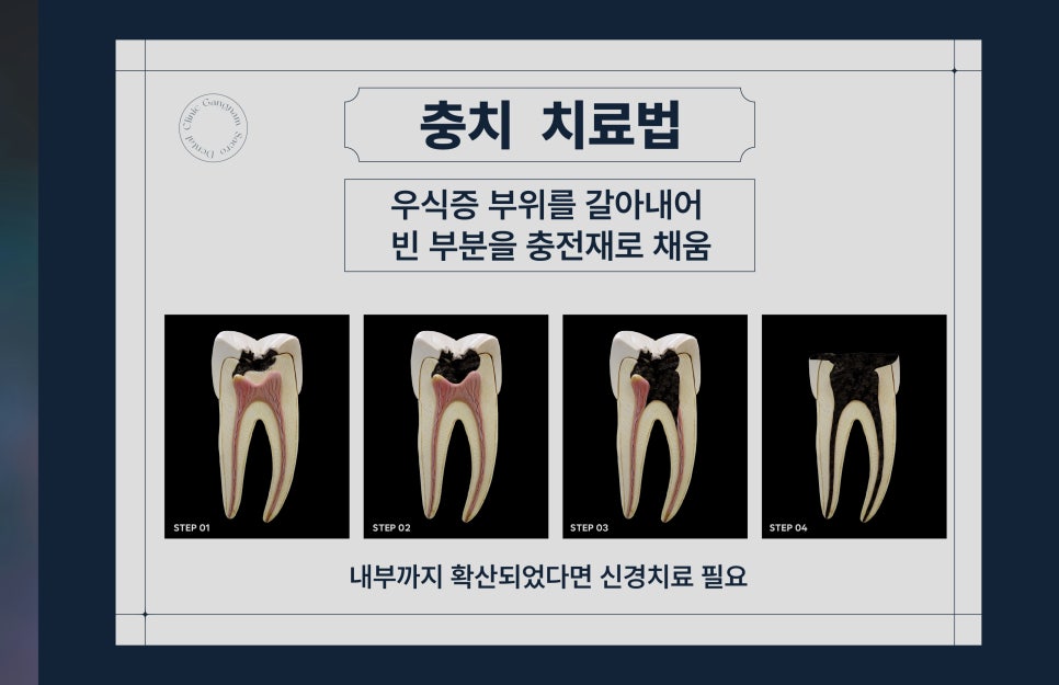 양심치과가 말해주는 모든 충치가 치료해야 하는 건 아니다? (정지성충치) 관련 이미지 3