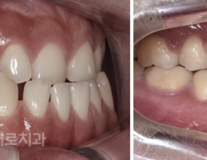 양악전 교정과 양악후 교정, 진행 방법의 차이를 알아보자. 관련 이미지 9
