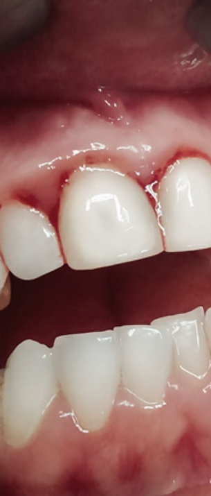 치은염 증상 어떠한 문제들이 있을까요? 관련 이미지 9