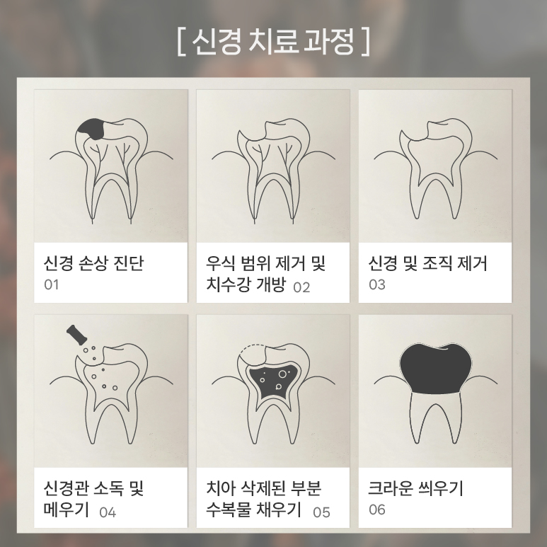 발치 전 최후의 수단 자연치아보존 (치근단절제술) 관련 이미지 4