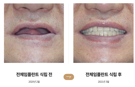 An Efficient Choice When Only a Few Teeth Remain (Full-Mouth Implant Effect) image 2