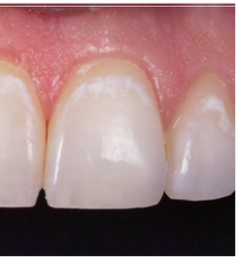 탕후루 치아 손상을 유발? 치료 방법 및 후기 관련 이미지 5