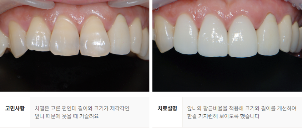 강남역 무삭제 라미네이트 (에어네이트) 관련 이미지 8