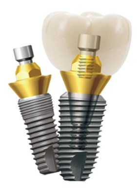 임플란트종류 자세히 알아보기 (4) 임플란트회사 덴티움 관련 이미지 2