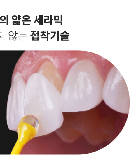 풍자 라미네이트? 치아 삭제 없는 과정으로 관련 이미지 6