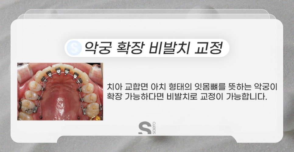치아교정할 때 발치해야 하는 이유 (비발치중심 치아교정) 관련 이미지 4