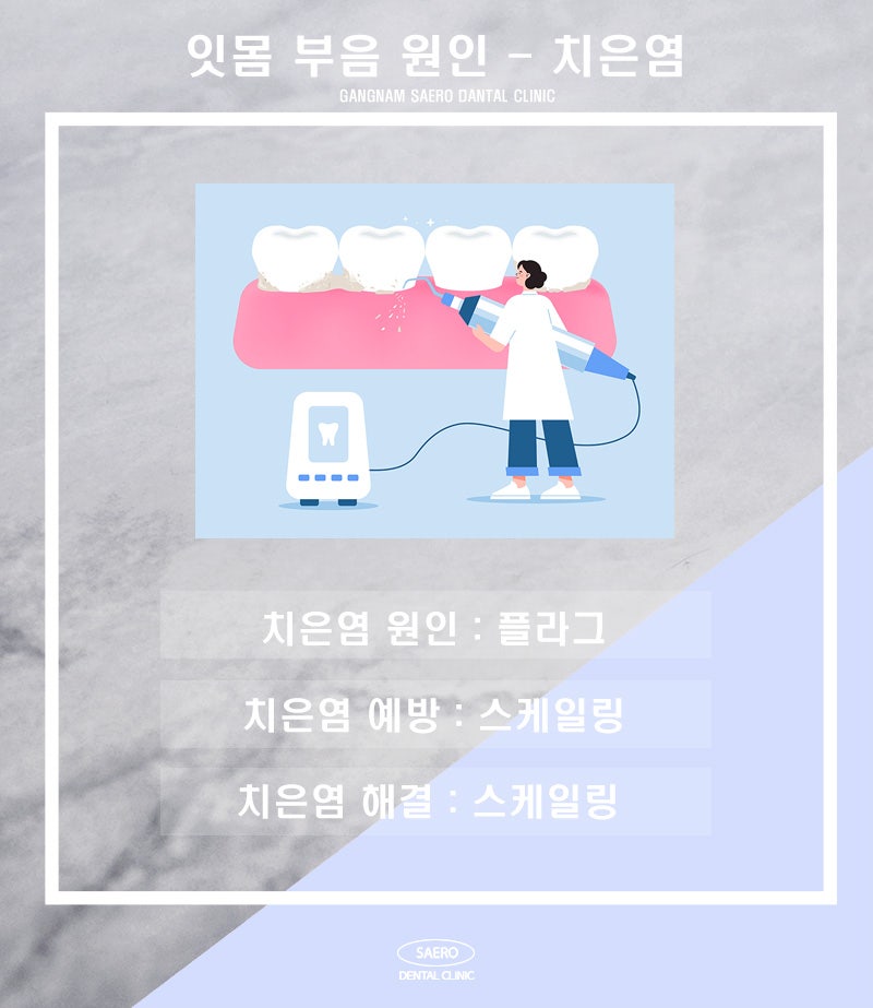 갑자기 잇몸 부을 때 정확한 원인과 올바른 해결 방법 (잇몸부음이유) 관련 이미지 2