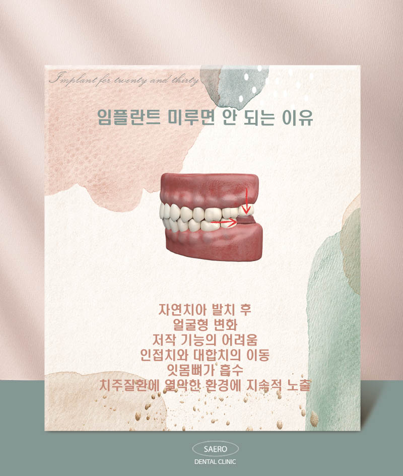 MZ세대 2030을 위한 임플란트 (당일임플란트) 관련 이미지 2