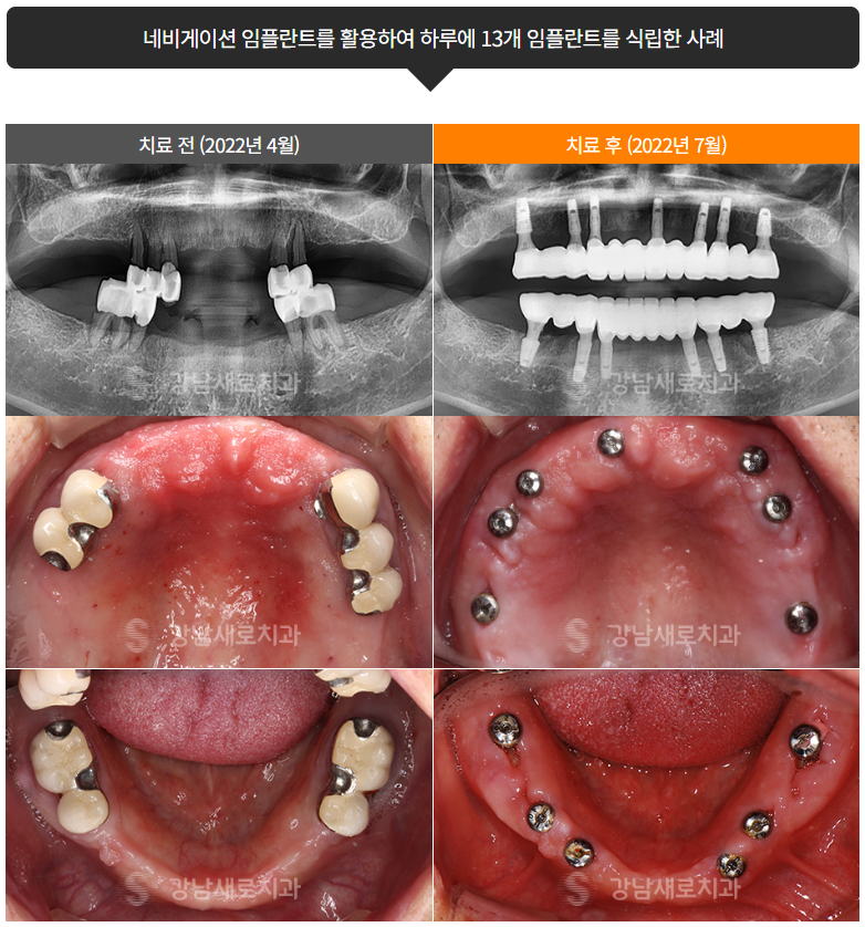 붓기, 출혈, 통증 최소화 임플란트 (네비게이션임플란트) 관련 이미지 4