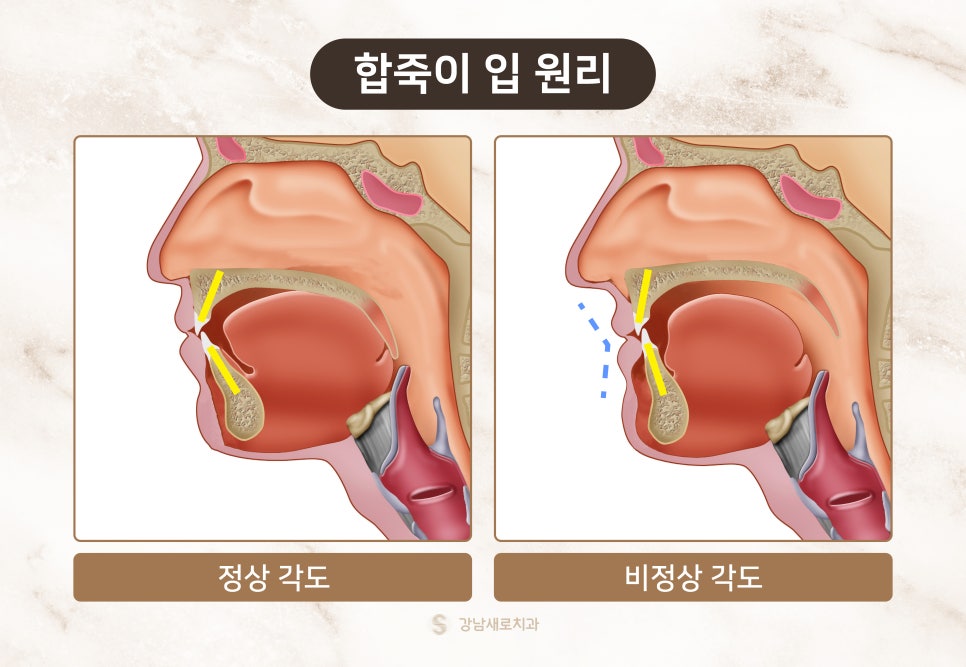 교정 부작용 자세히 알아보기 - 얼굴 변화 원리와 이유 [ 예방 및 대처 방법 ] [ 강남새로치과 ] 관련 이미지 3