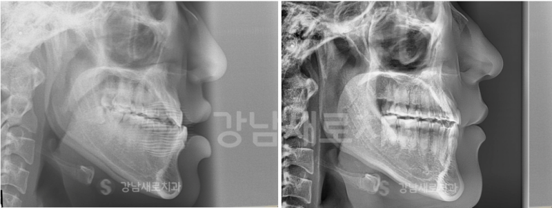 강남역교정치과를 찾고 계신다면? 비발치로 해결하세요! 관련 이미지 7