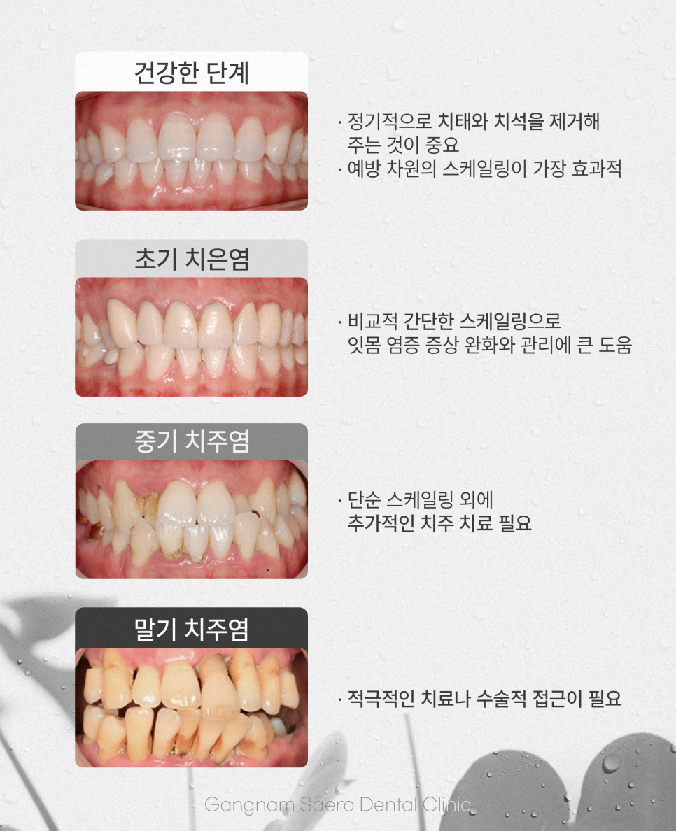 치주질환 예방 가글 마취로 편안한 스케일링 (무통스케일링) 관련 이미지 2
