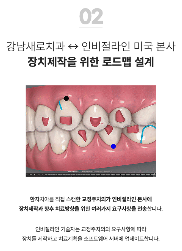 투명치아교정, 발치없이 인비절라인으로 치료 진행 관련 이미지 5