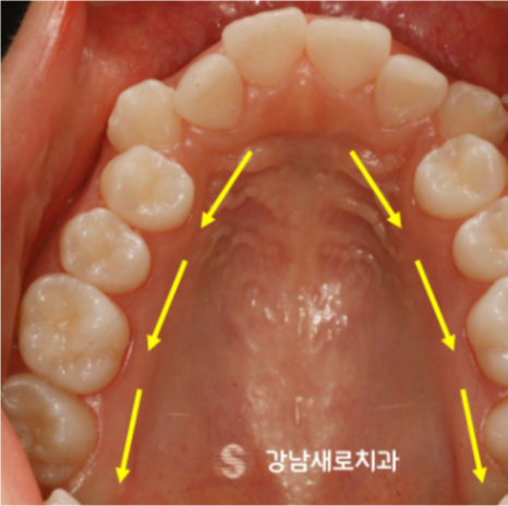 비발치교정 치료, 발치 없이 진행하는 과정 관련 이미지 5